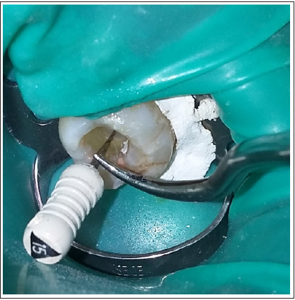 Passive Ultrasonic Irrigation in Endodontics: A Simple Innovative ...